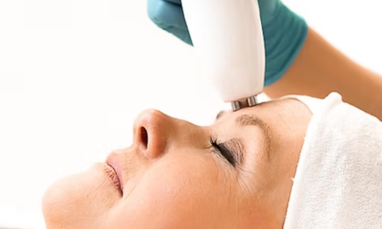 RF-microneedling-gelaatsbehandeling met zalm-DNA of exosomen