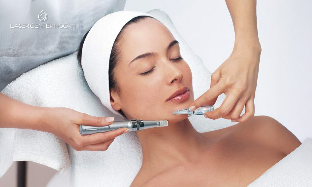 1 of 2 microneedling-behandeling(en) naar keuze (45 of 60 min)