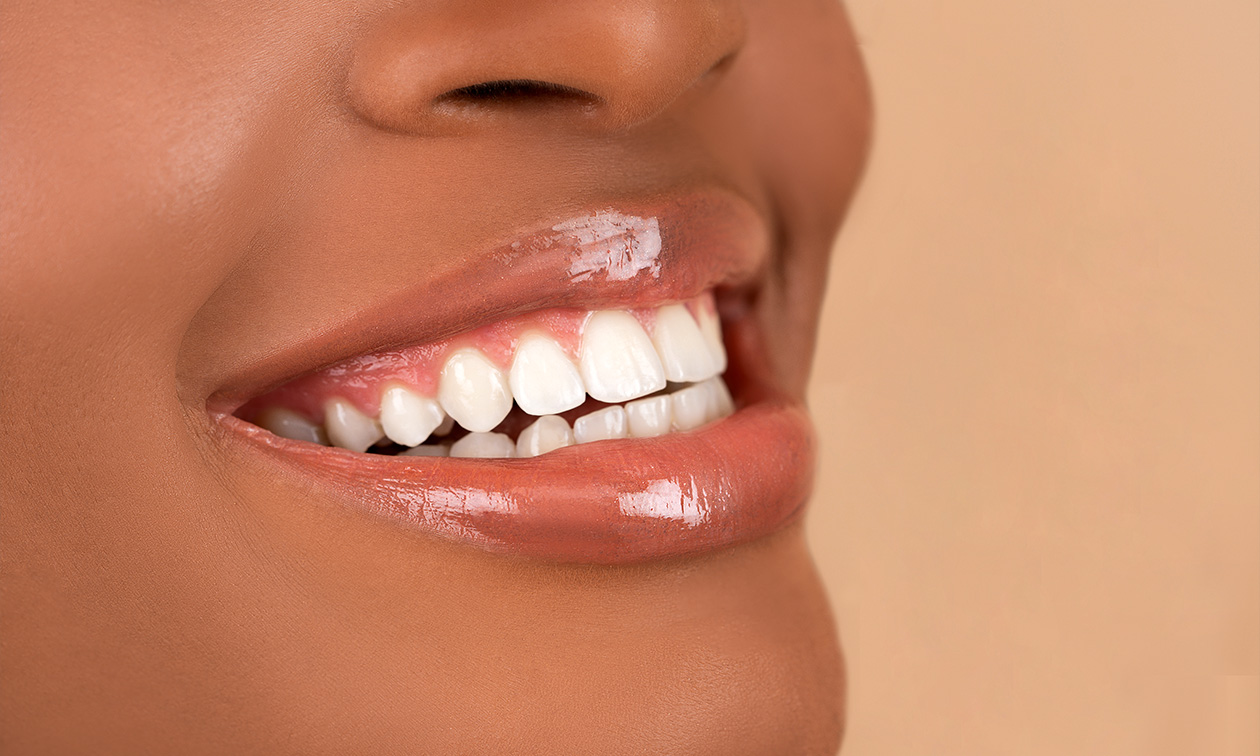 Tandenbleken (2x 20 min)